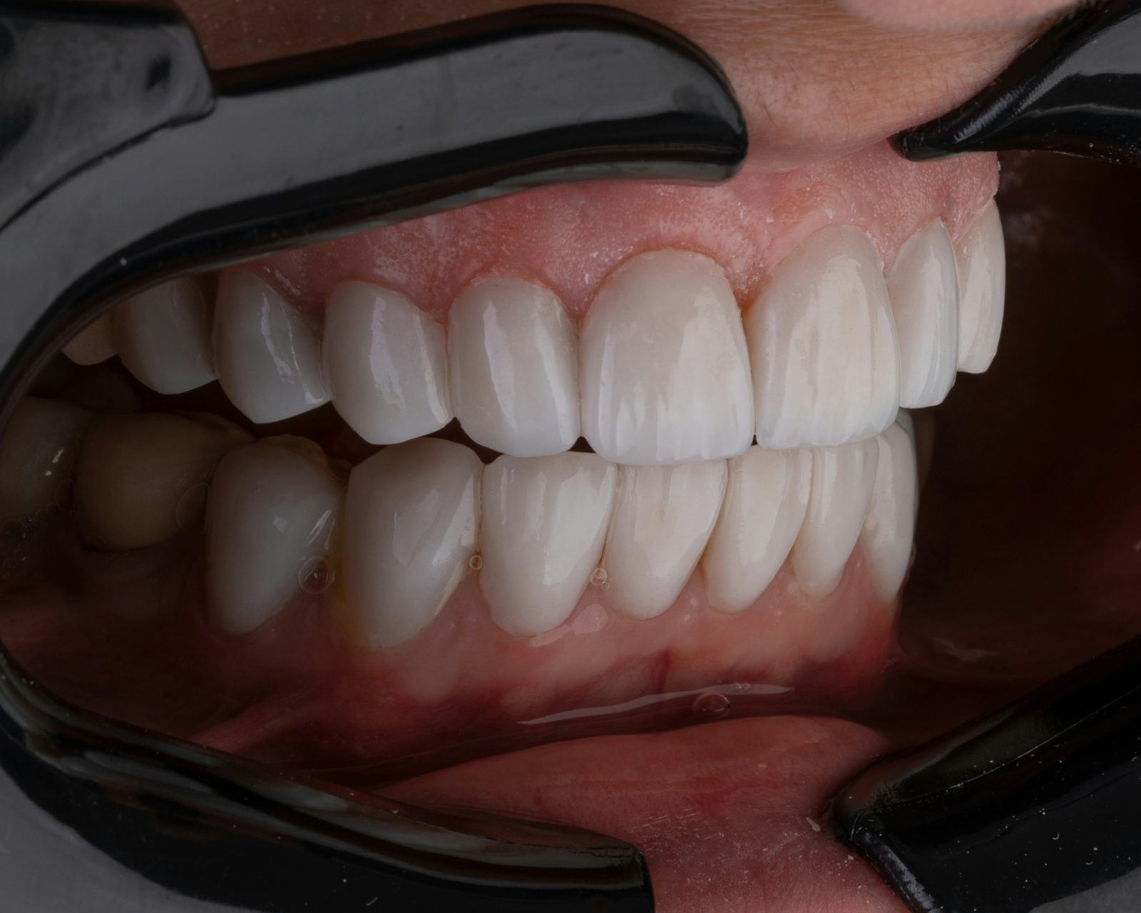 Patient with full-arch fixed implants smiling confidently