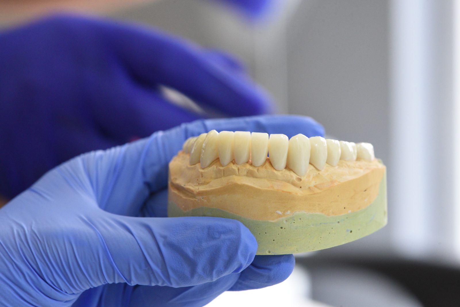 Patient showing natural-looking implant bridge result