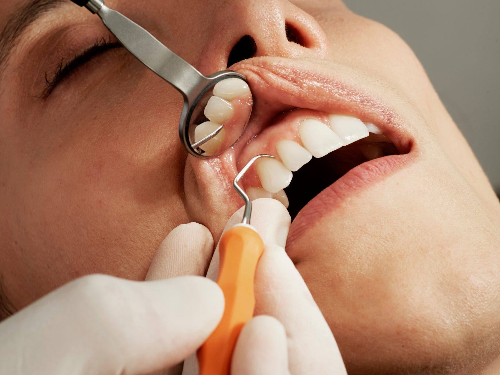 Patient showing confident smile with snap-in dentures